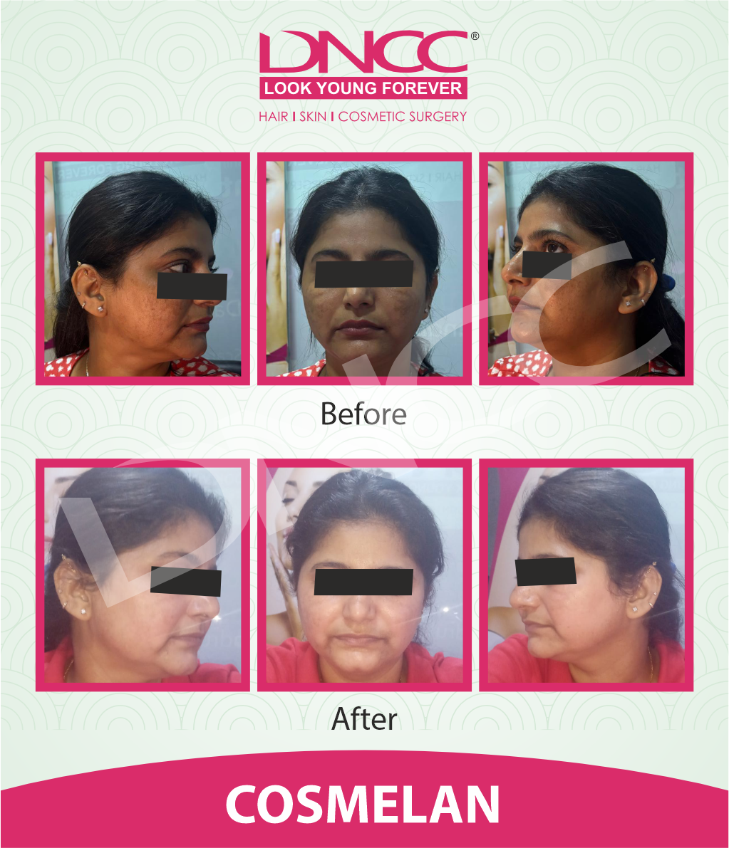 Hair Transplant Transformation 1